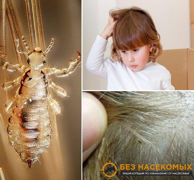Как вывести вшей у детей